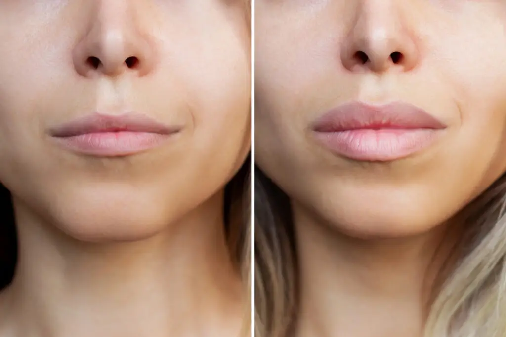 result of lip augmentation. cropped shot of young blonde woman's lower part of face with lips before and after lip enhancement. injection of filler in lips. difference, comparison