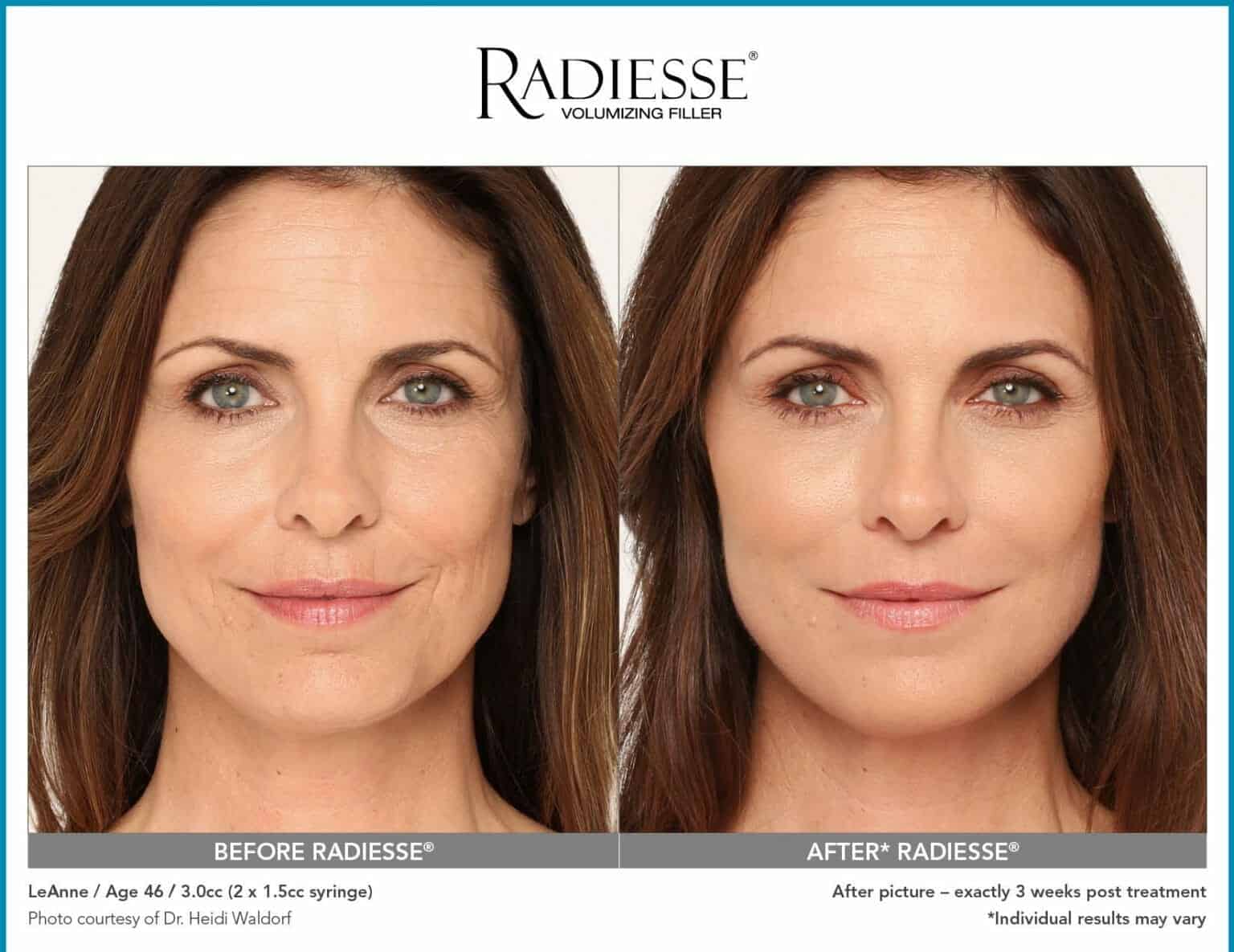 radiesse before after photo biostimulator