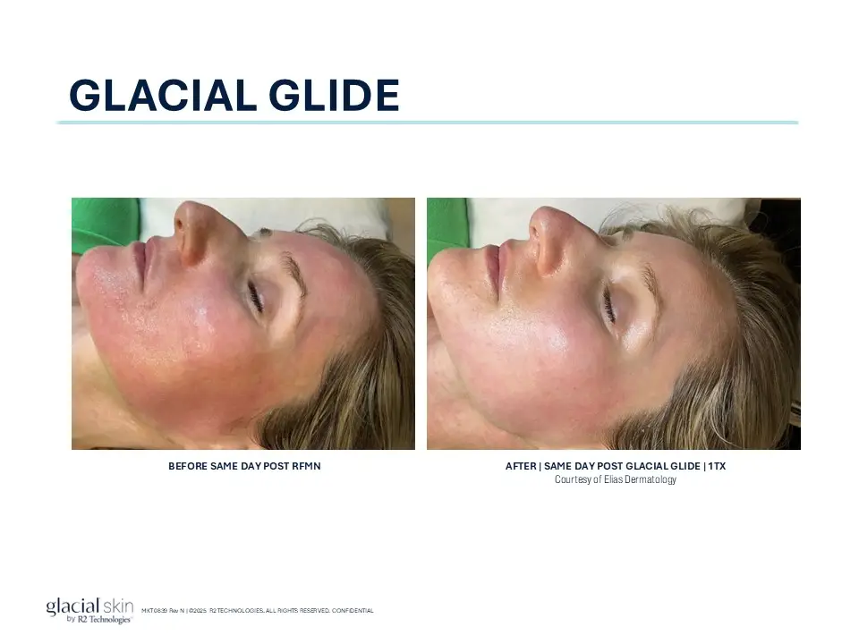 Glacial Glide before and after showing improvement in facial redness