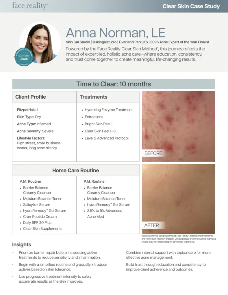 Face Reality acne treatment case study showing before and after results
