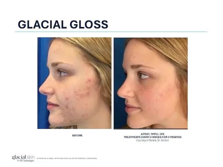 Glacial Gloss before and after facial treatment results